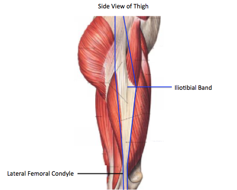 IT Band Syndrome - Physical Therapy 101